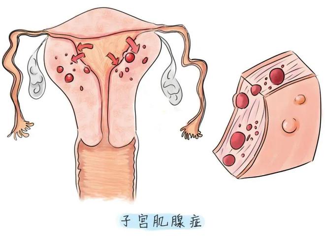 子宫腺肌症